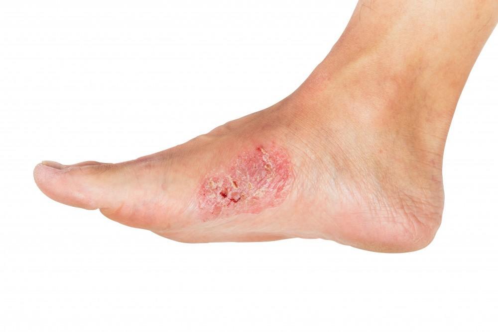 How to Tell if Your Blister Is Infected: Neuhaus Foot &amp; Ankle ...