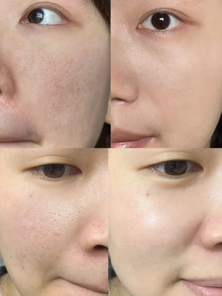 安全微針：如何選擇專業美容院？